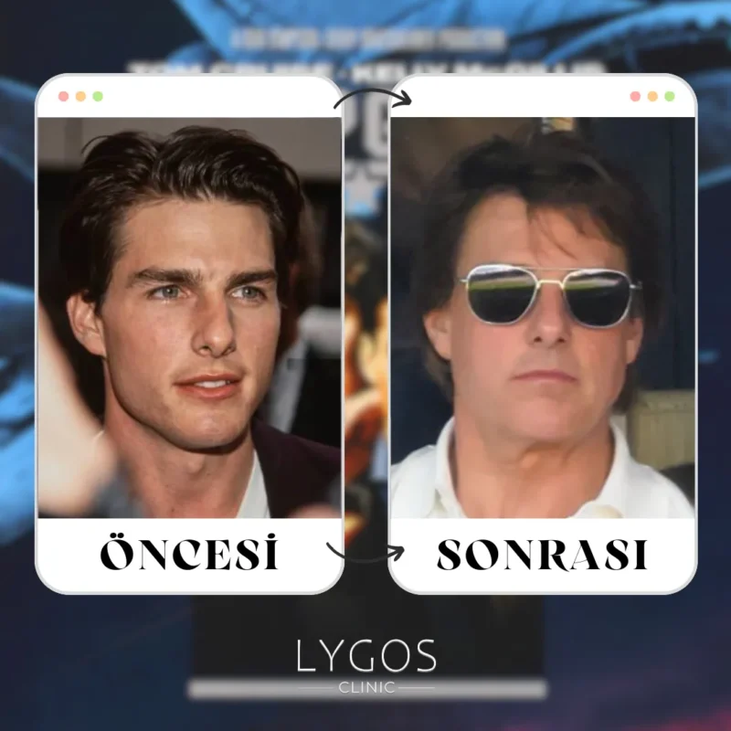 Tom Cruise Burun Estetiği
