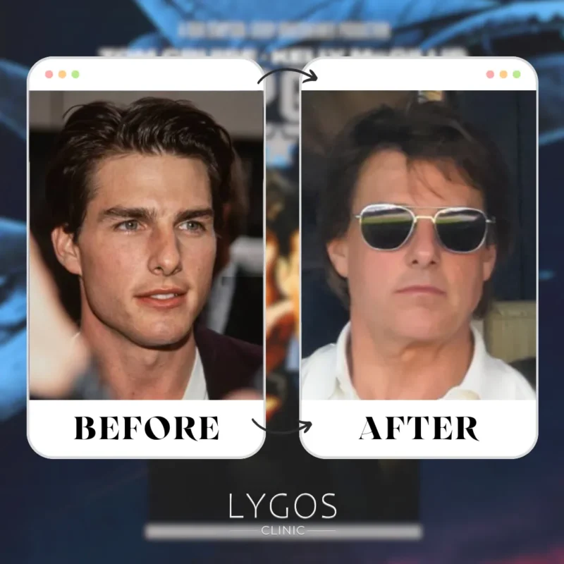 Tom Cruise Rhinoplasty