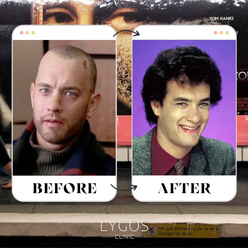 Tom Hanks Hair Transplant