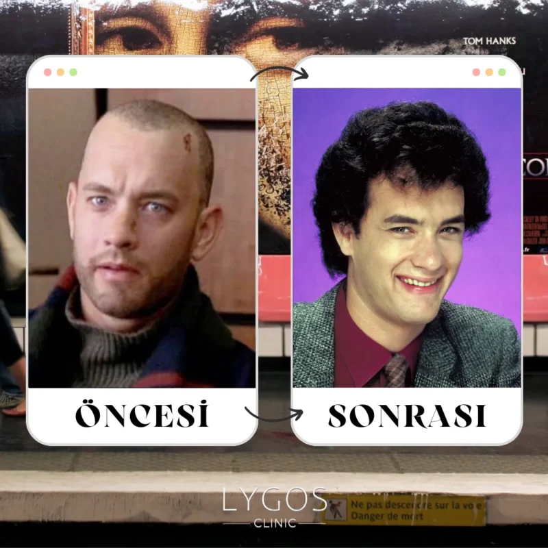 Tom Hanks Saç Ekimi