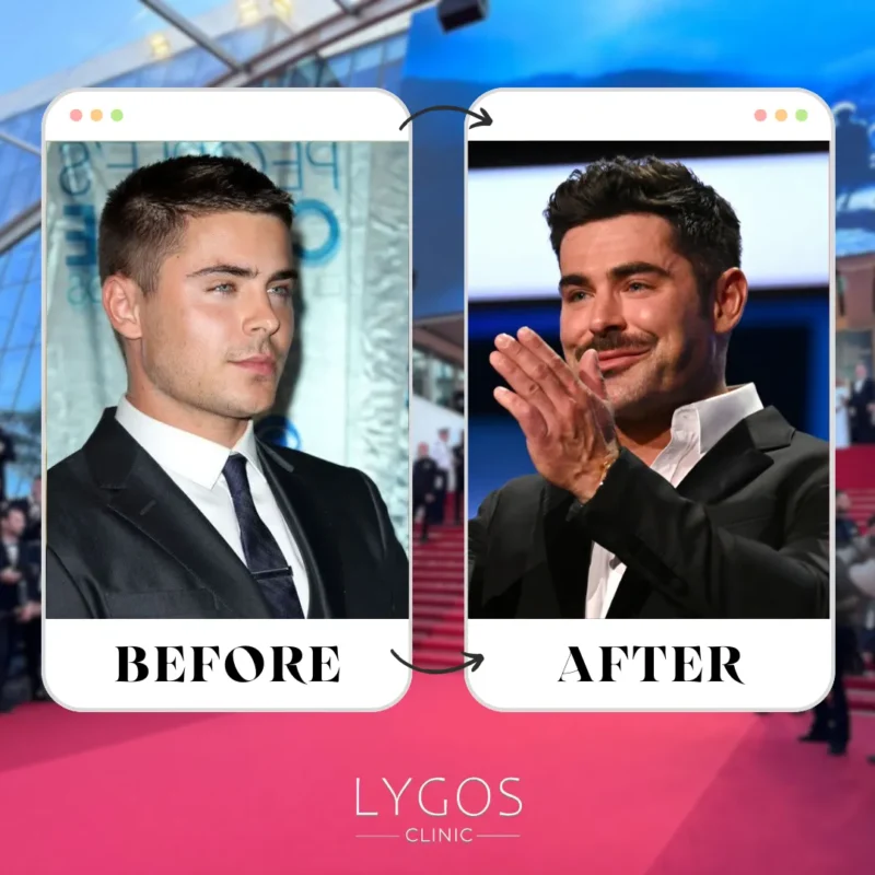 Zac Efron Hair Transplant
