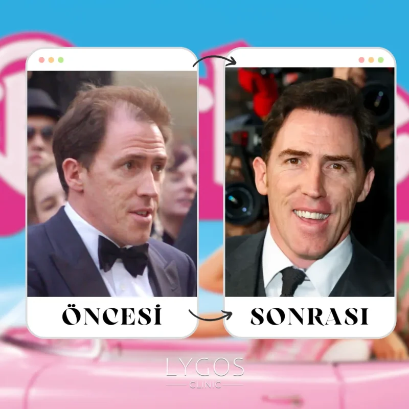 Rob Brydon Saç Ekimi