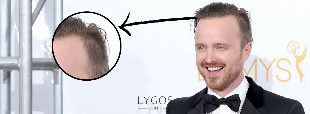 Aaron Paul Hair Loss