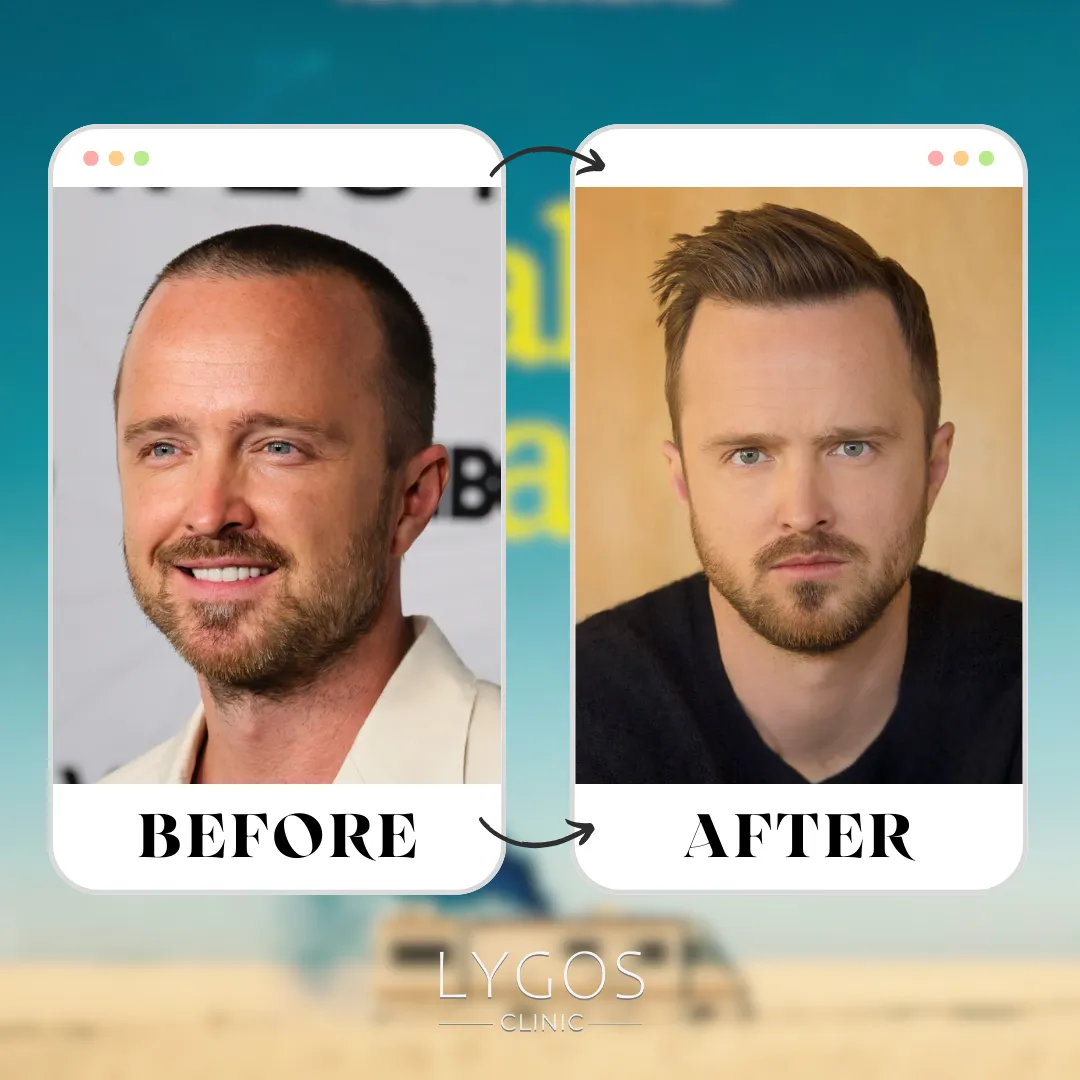 Aaron Paul Hair Transplant | Celebrities Hair Transplant 1 Aaron Paul Hair Transplant