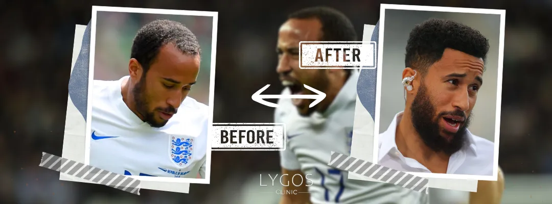 Andros Townsend Before and After Hair Transplant