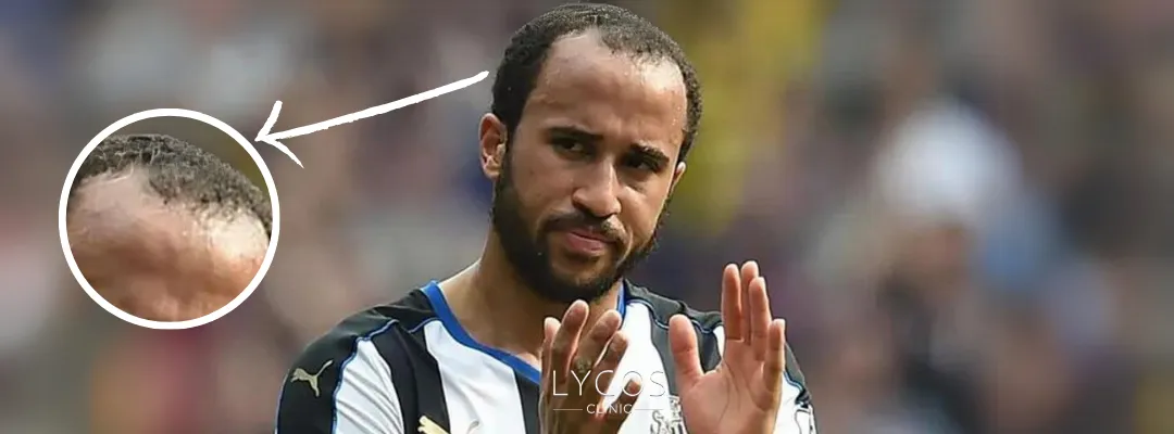 Andros Townsend Hair Loss