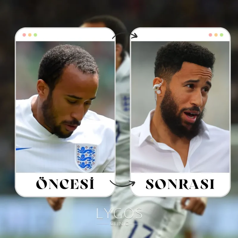 Andros Townsend Saç Ekimi