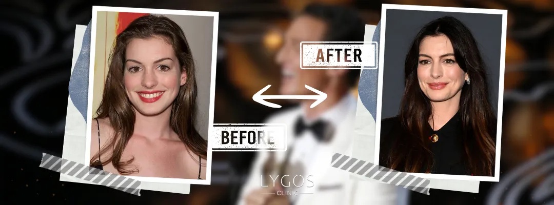 Anne Hathaway Rhinoplasty Before and After