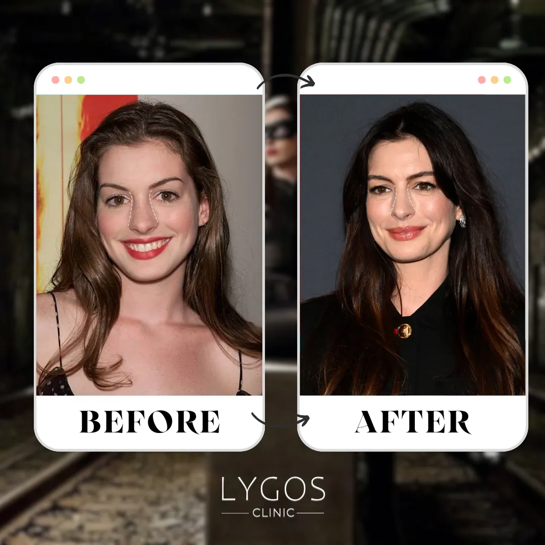 Anne Hathaway Rhinoplasty | Celebrities Nose Job 1 Anne Hathaway Rhinoplasty