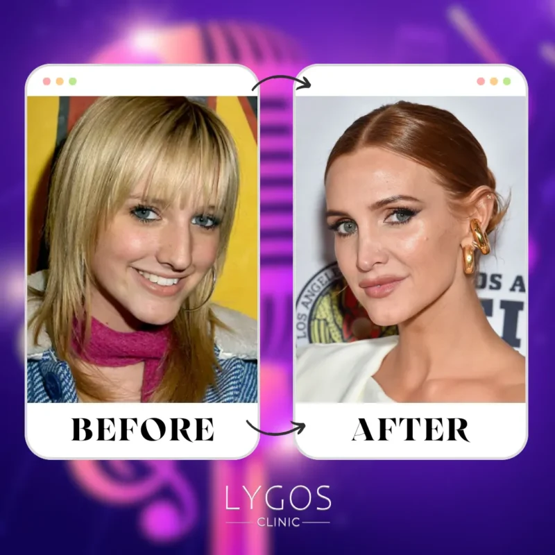 Ashlee Simpson Rhinoplasty