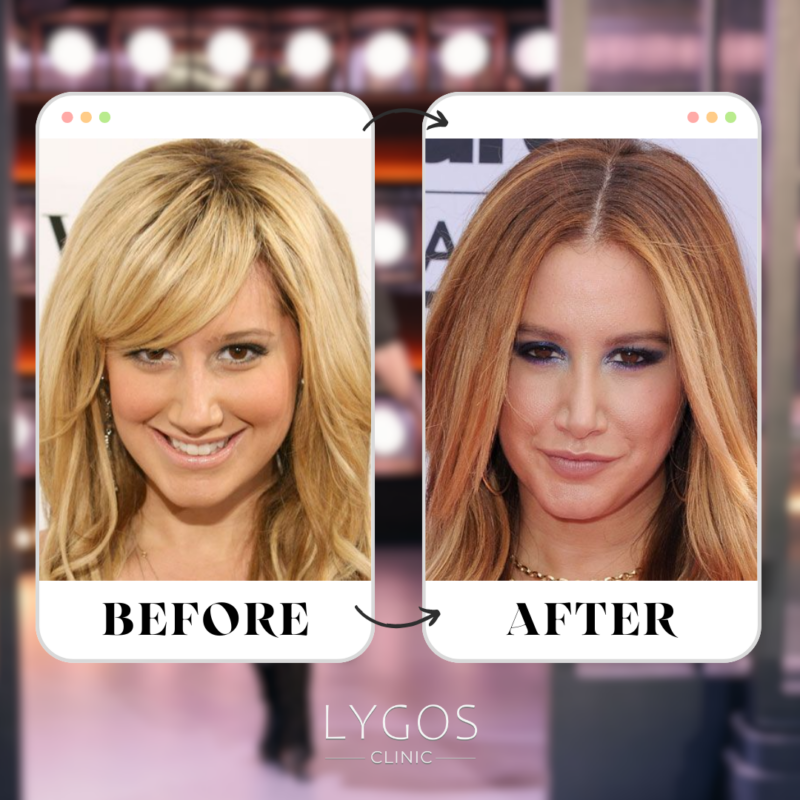 Ashley Tisdale Rhinoplasty