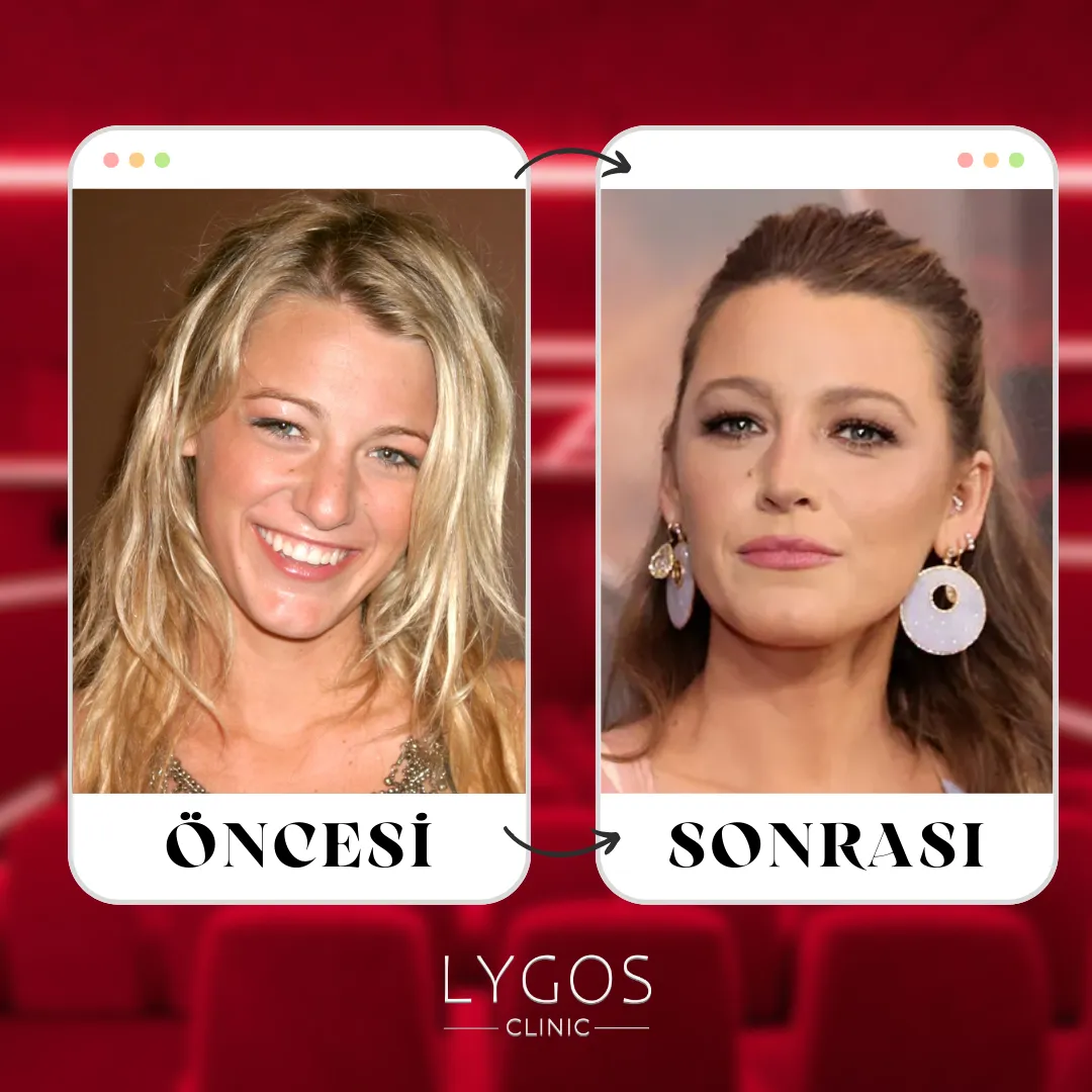 Blake Lively Burun Estetiği | Ünlülerde Burun Estetiği 1 Blake Lively Burun Estetiği
