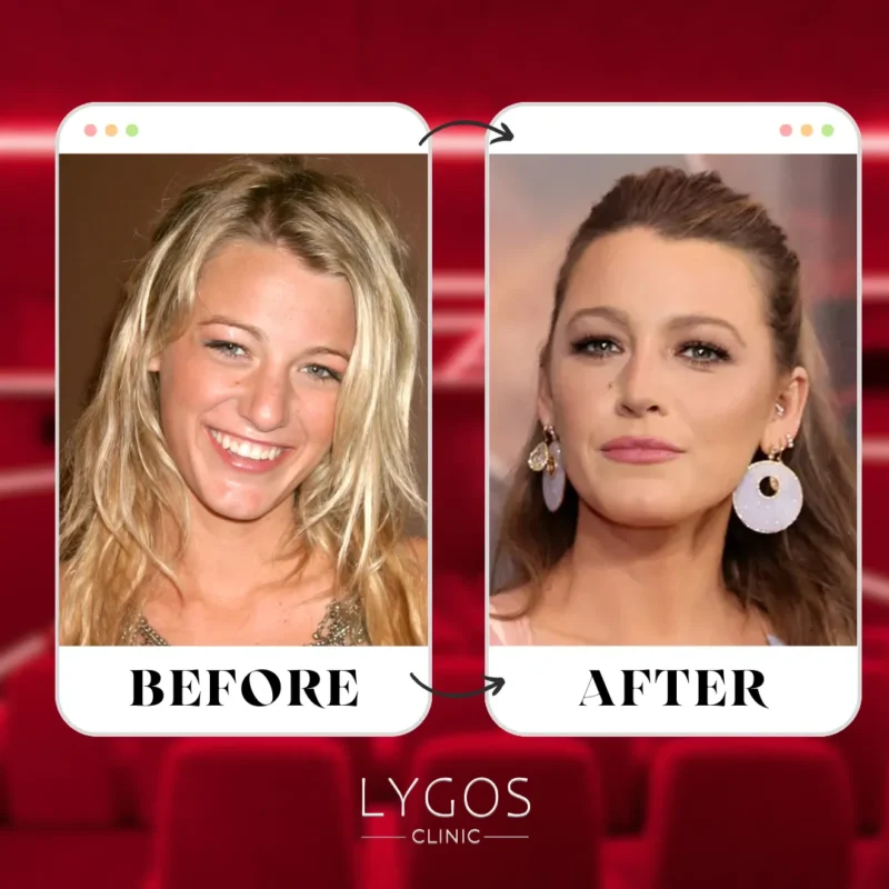Blake Lively Rhinoplasty