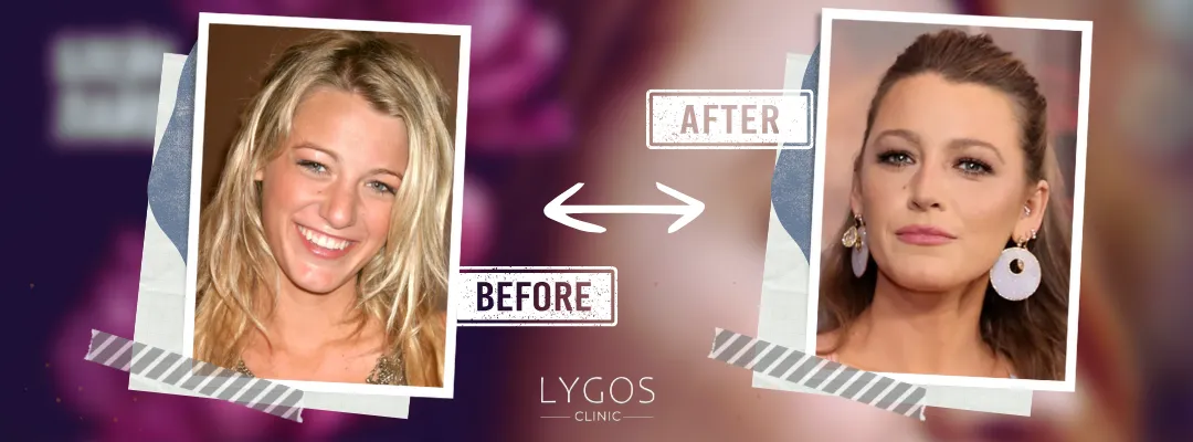 Blake Lively Rhinoplasty Before and After