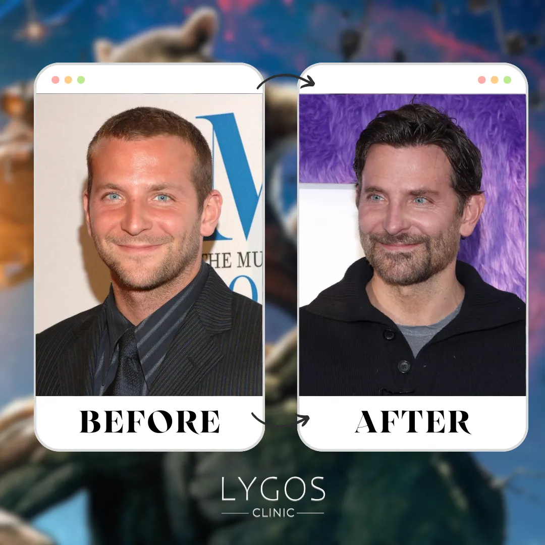 Bradley Cooper Hair Transplant | Celebrity Hair Transplant 1 Bradley Cooper Hair Transplant