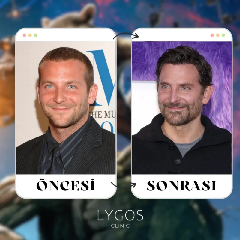 Bradley Cooper Saç Ekimi
