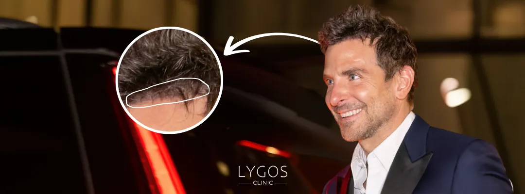 Bradley Cooper Saç Ekimi Yaptı Mı?