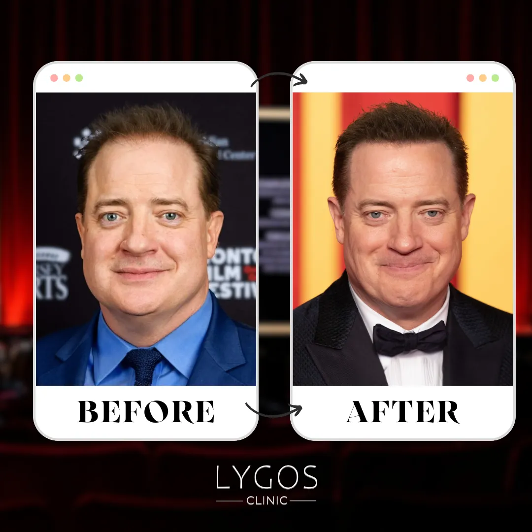 Brendan Fraser Hair Transplant | Celebrities Hair Transplant 1 Brendan Fraser Hair Transplant