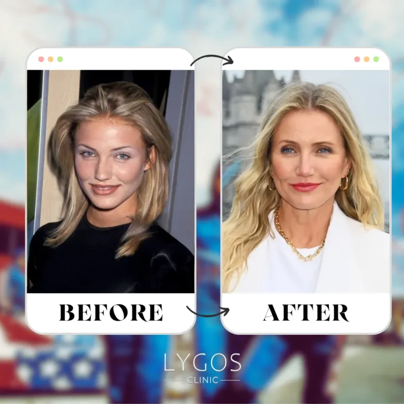 Cameron Diaz Rhinoplasty