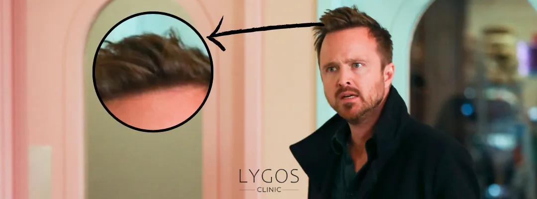 Did Aaron Paul Get an Hair Transplant?