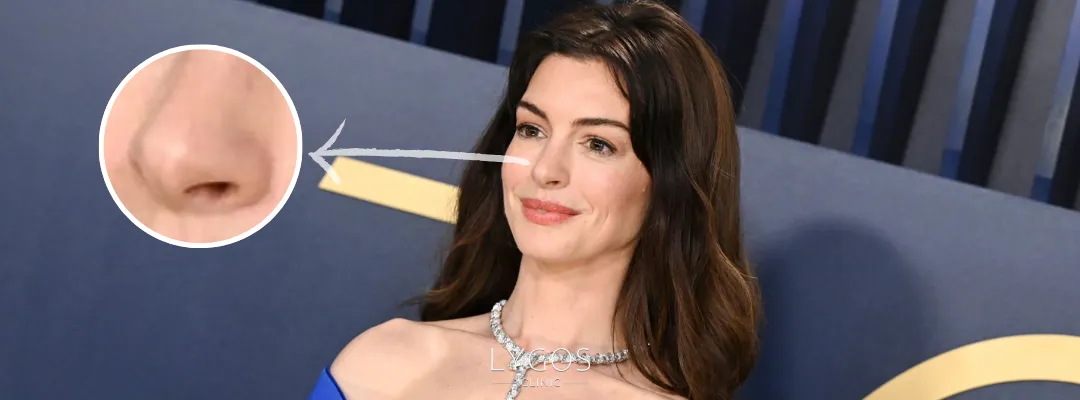 Did Anne Hathaway Get A Nose Job?