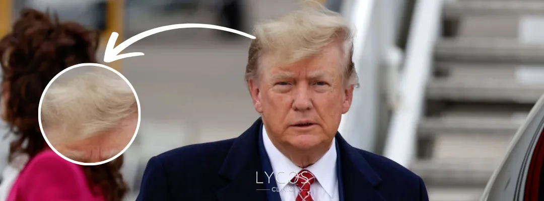 Did Donald Trump Get a Hair Transplant?