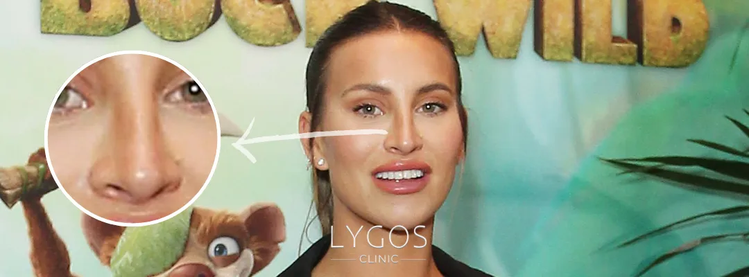 Ferne McCann Rhinoplasty | Celebrities Nose Job 3 Did Ferne McCann Get A Nose Job?