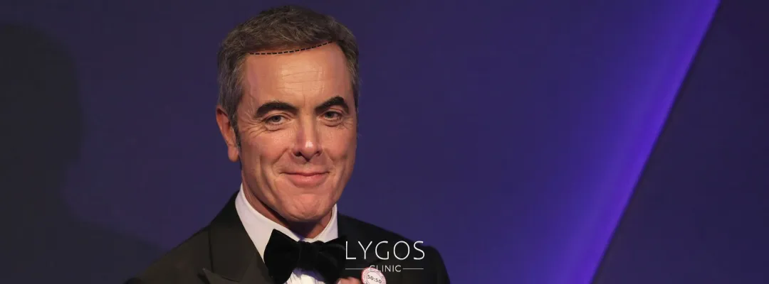 Did James Nesbitt Get a Hair Transplant?