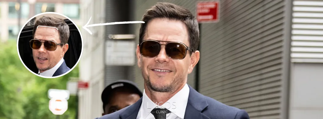 Did Mark Wahlberg Get a Hair Transplant?