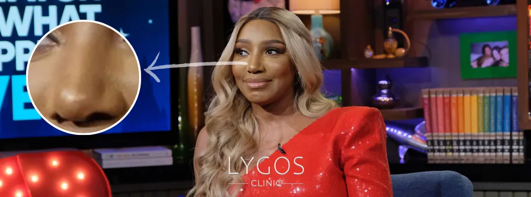 Did NeNe Leakes Get A Nose Job?