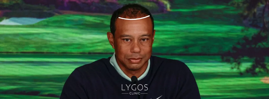 Did Tiger Woods Get a Hair Transplant?