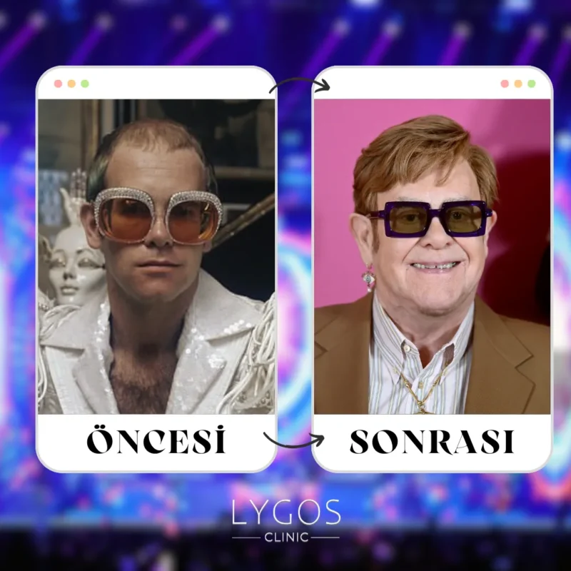 Elton John Saç Ekimi