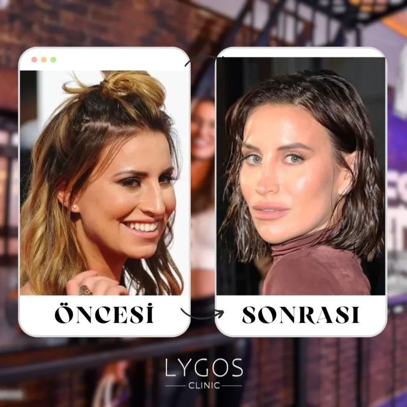 Ferne McCann Burun Estetiği