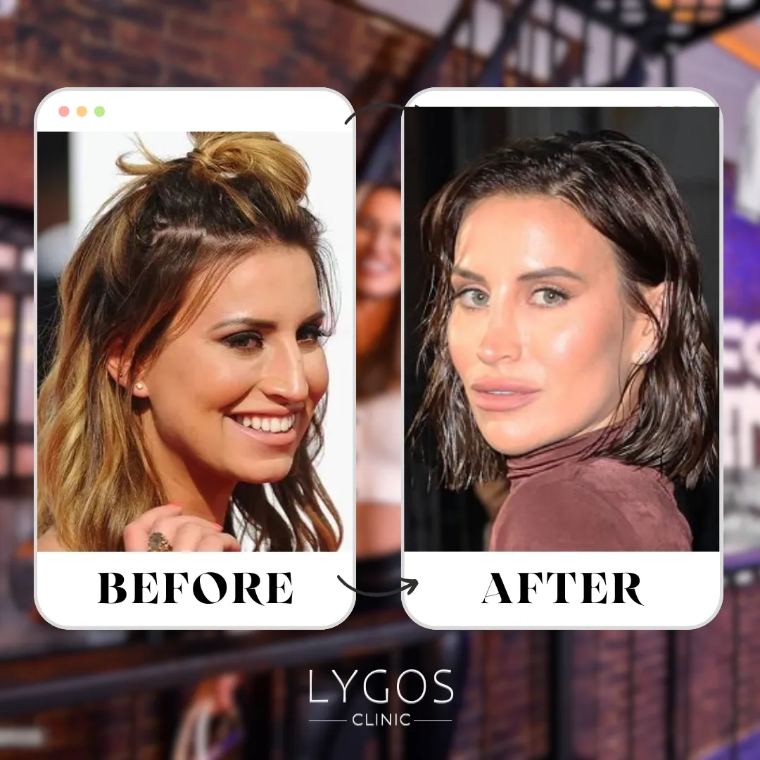 Ferne McCann Rhinoplasty | Celebrities Nose Job 1 Ferne McCann Rhinoplasty