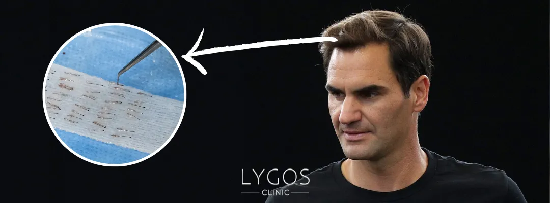 How Many Grafts of Hair Transplant Could Roger Federer Had?