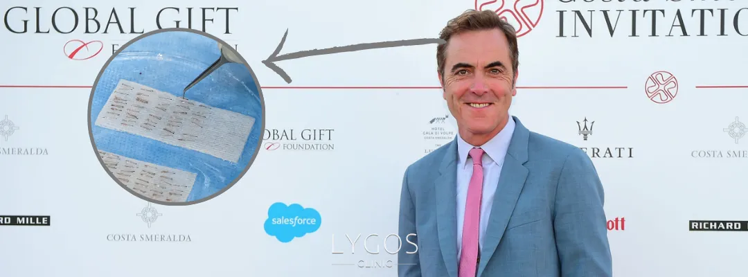 How Many Grafts of Hair Transplant Was Performed on James Nesbitt?