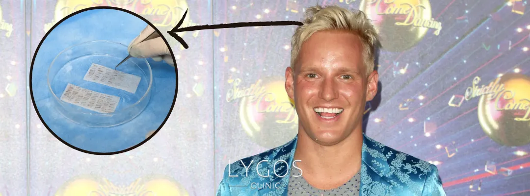 How Many Grafts of Hair Transplant Was Performed on Jamie Laing?