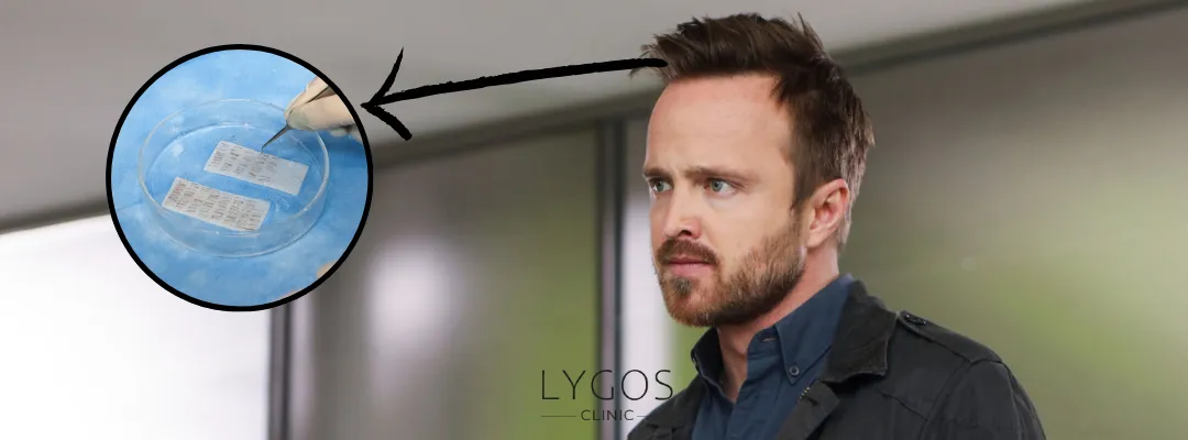 How Many Grafts of Hair Transplant Were Performed on Aaron Paul?