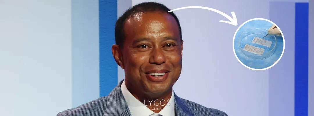 How Many Grafts of Hair Transplant Were Performed on Tiger Woods?