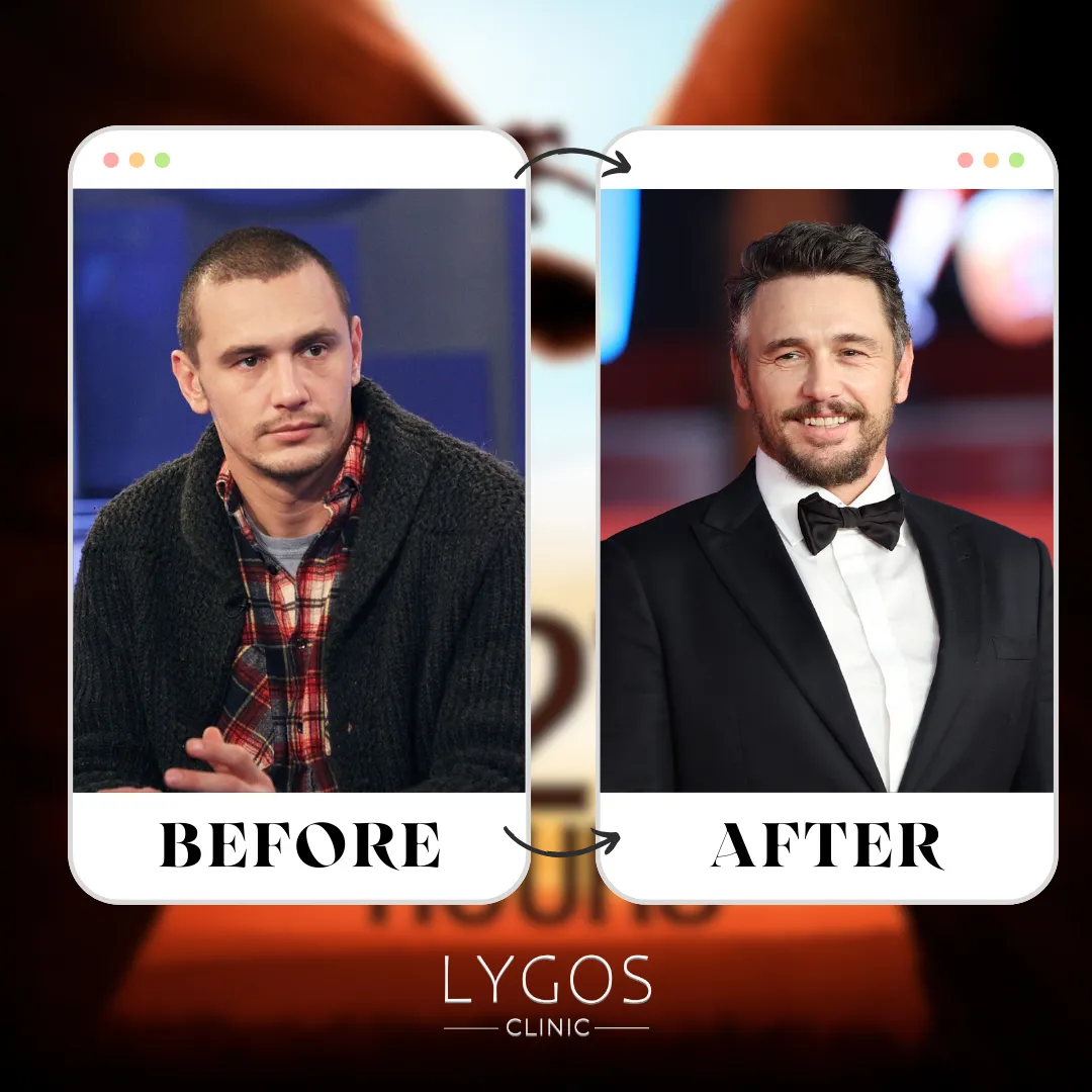 James Franco Hair Transplant | Before and After 1 James Franco Hair Transplant