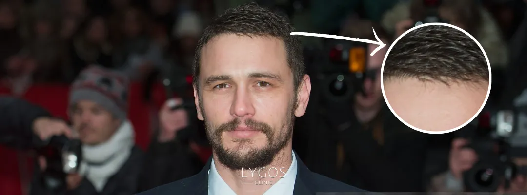 James Franco Saç Dökülmesi