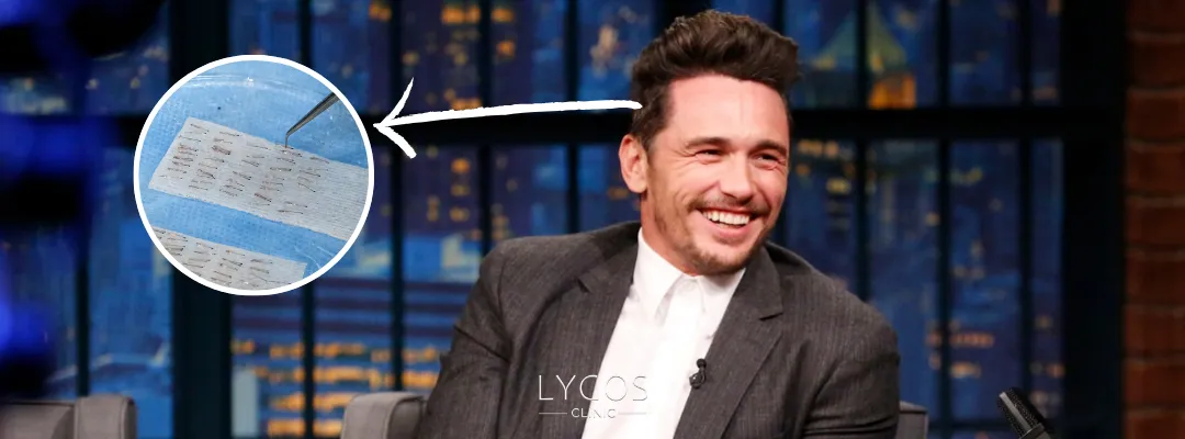 James Franco'ya Kaç Greft Saç Ekildi?