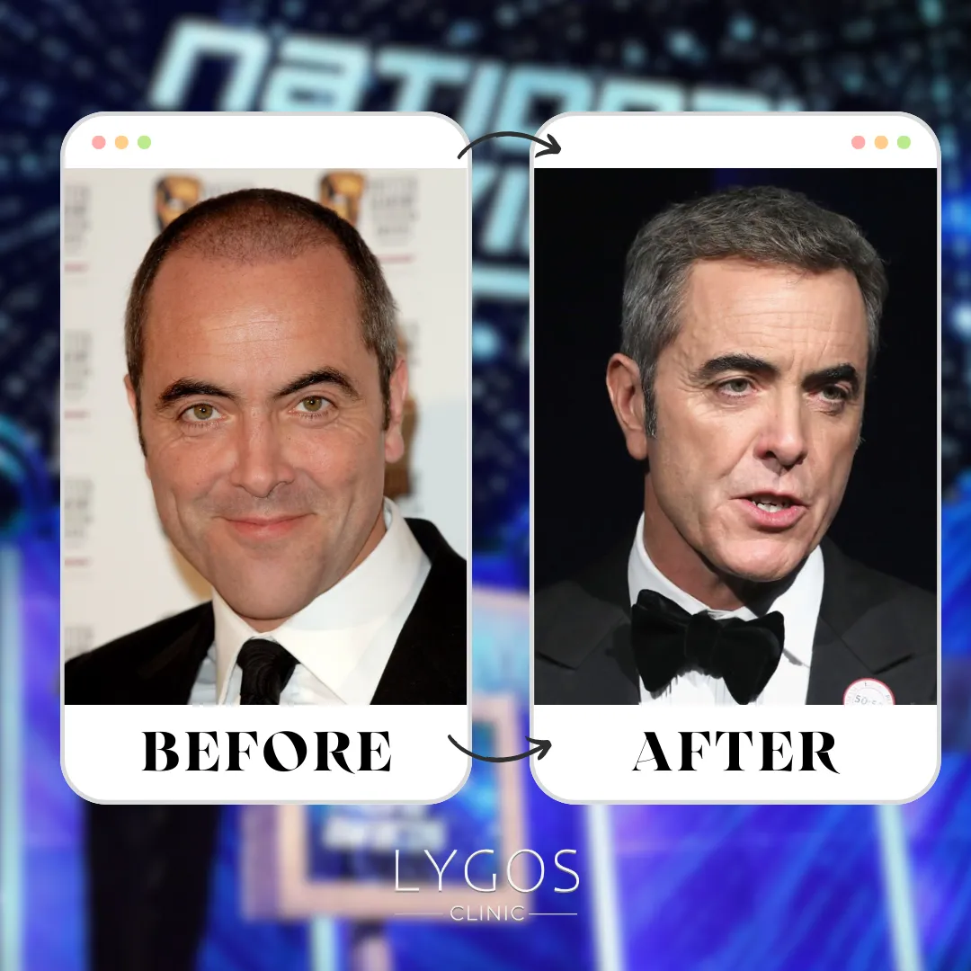 James Nesbitt Hair Transplant | Celebrities Hair Transplant 1 James Nesbitt Hair Transplant