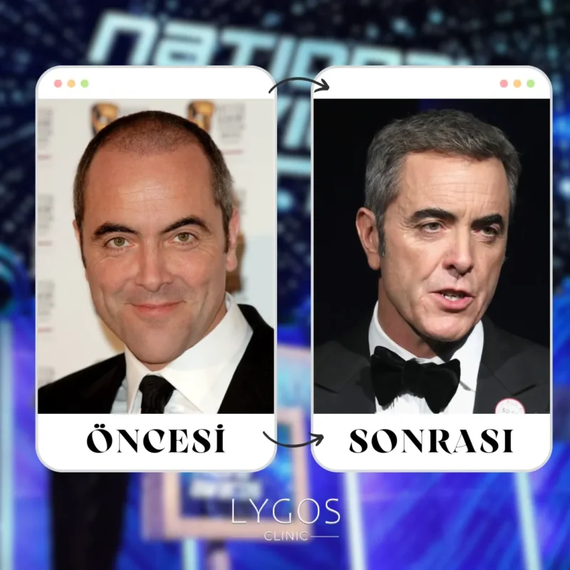 James Nesbitt Saç Ekimi
