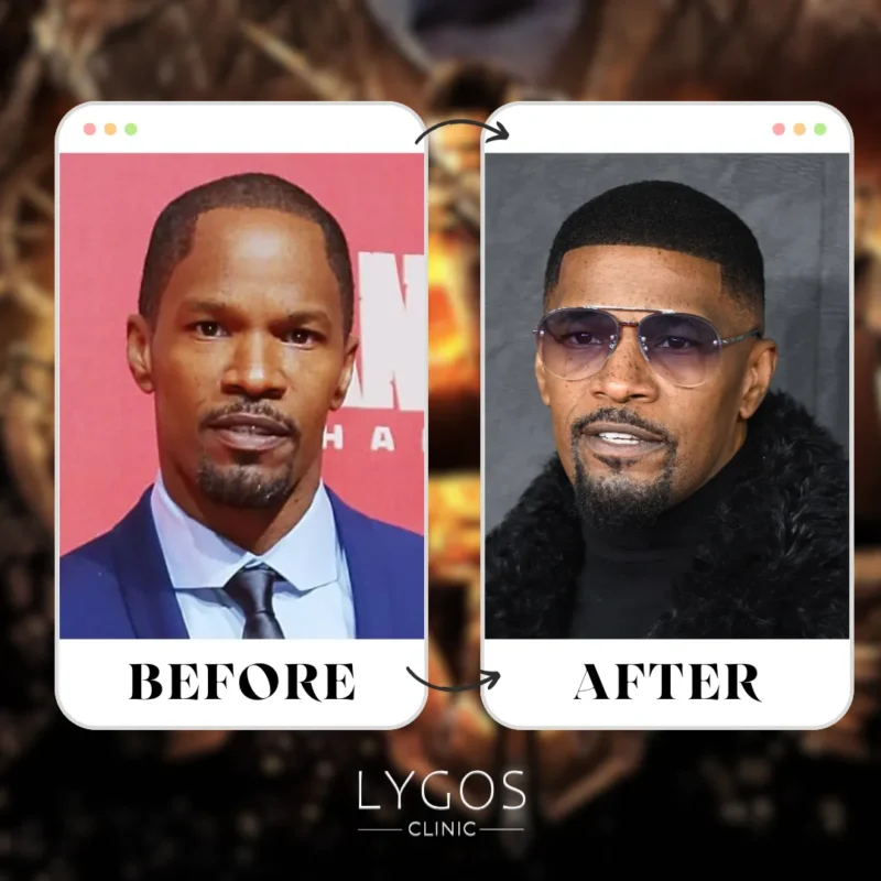 Jamie Foxx Hair Transplant