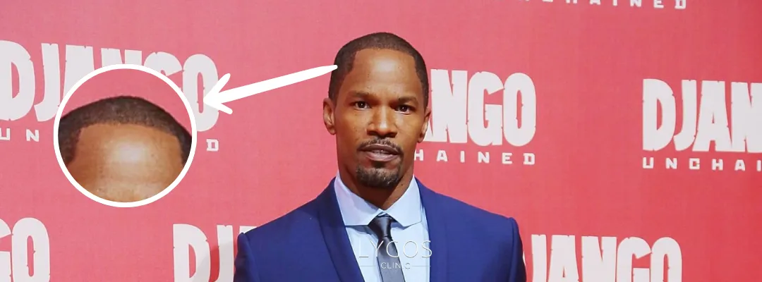 Jamie Foxx Saç Dökülmesi