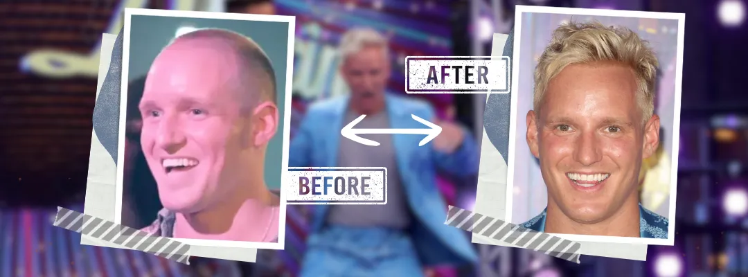 Jamie Laing Before and After Hair Transplant