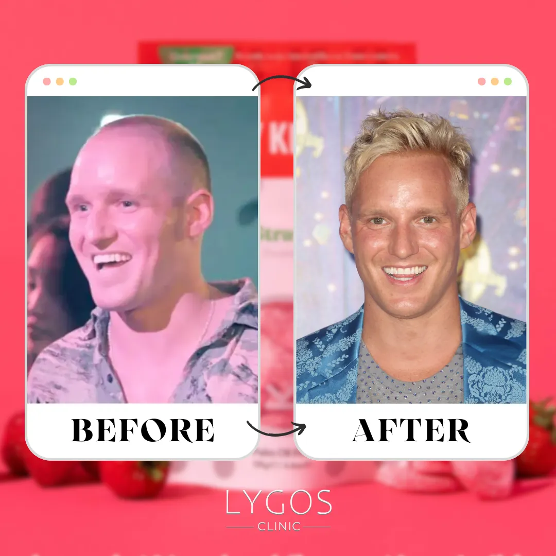 Jamie Laing Hair Transplant | Celebrities Hair Transplant 1 Jamie Laing Hair Transplant