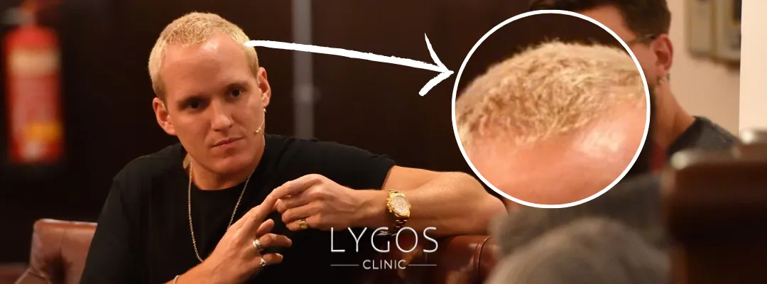 Jamie Laing Saç Dökülmesi