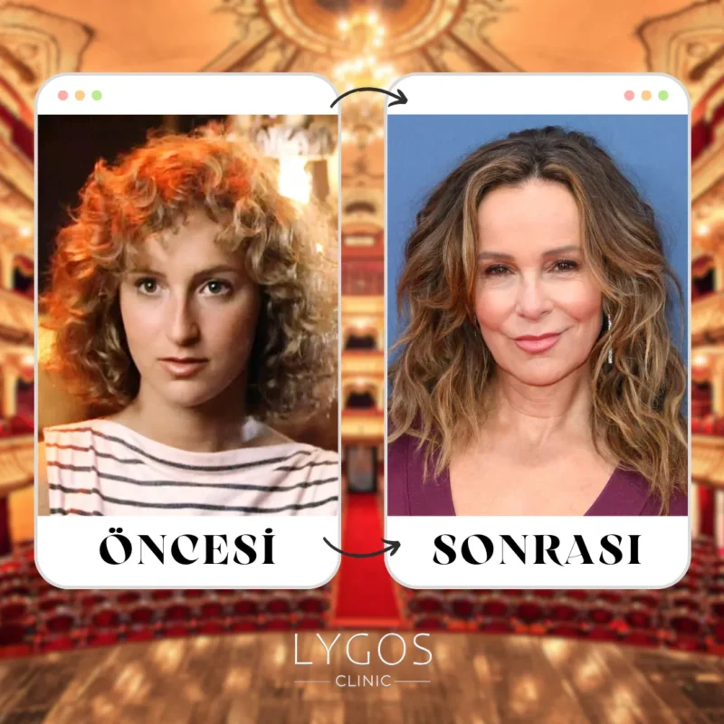 Jennifer Grey Burun Estetiği